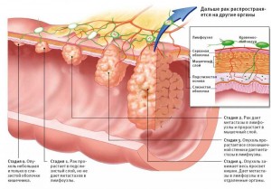 стадии рака кишечника